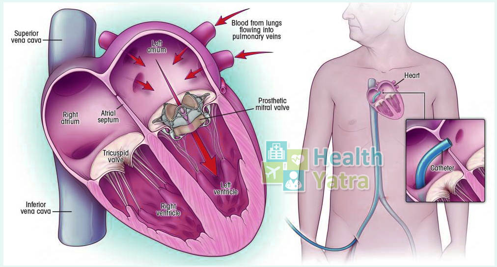 جراحة استبدال صمام القلب الأبهري في الهند باستخدام HealthYatra