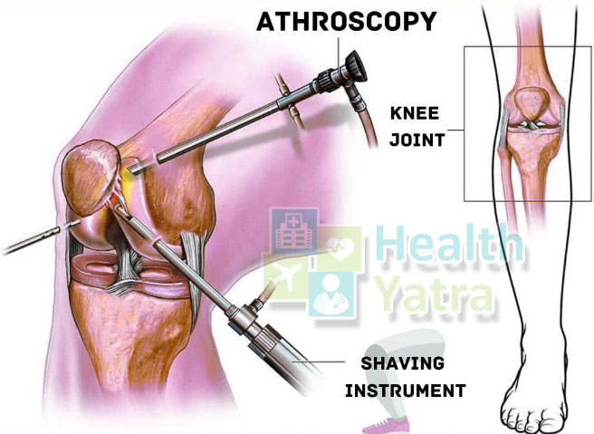 Arthroscopic Knee Surgery in India is an Ideal Procedure for Most Knee Problems