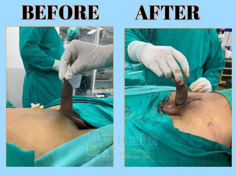 हेल्थयात्रा के साथ भारत में किफायती फैलोप्लास्टी सर्जरी का लाभ उठाएं