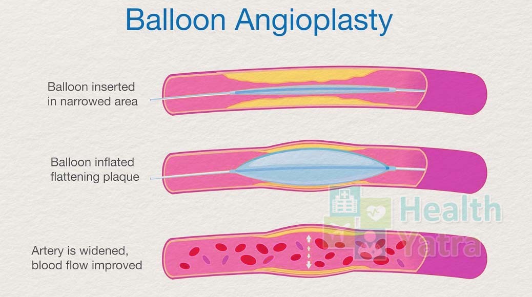 Balloon Angioplasty Procedure in India
