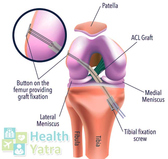 Connect with HealthYatra for Affordable ACL Surgery In India