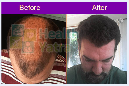 جراحة زراعة الشعر قبل وبعد