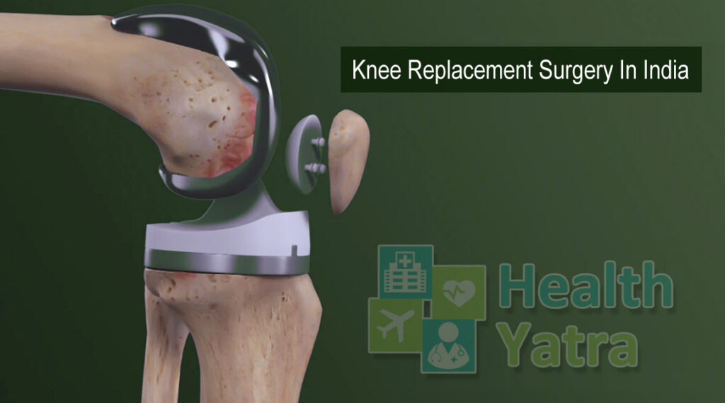 Knee Replacement Surgery In India