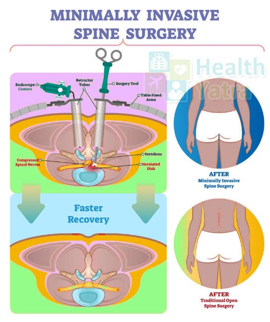 Laser Spine Surgery Verses Minimally Invasive Spine Surgery
