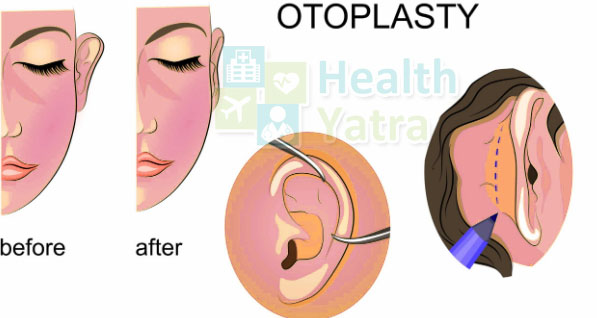 Low Cost Otoplasty Cosmetic Surgery in India