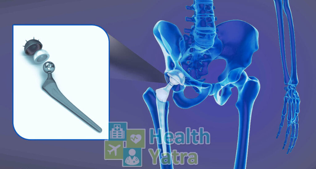Total Hip Replacement Surgery in India