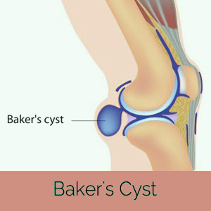 baker's cyst treatment india