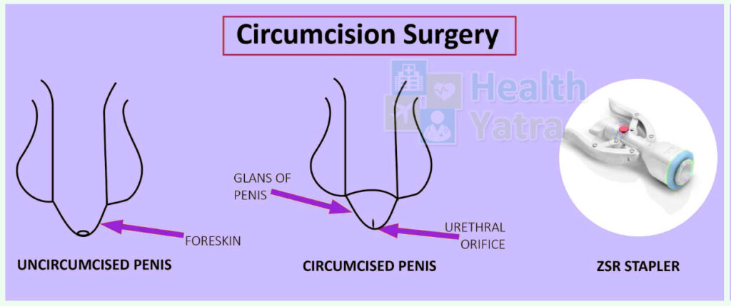 Circumcision Surgery Type in India