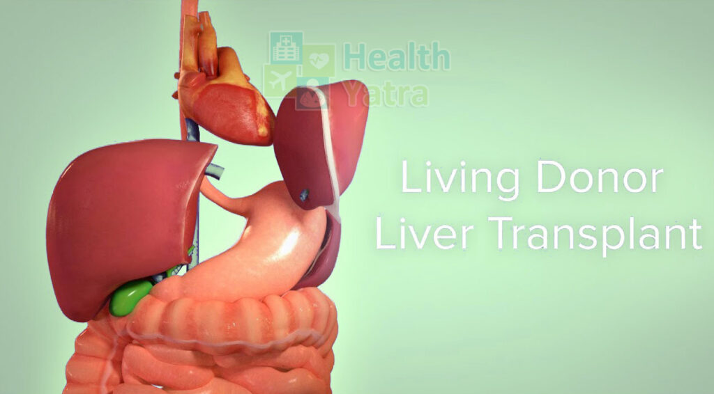 Live Donor Liver Transplant in india