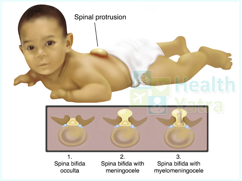 Spina Bifida Treatment in India: Causes, Signs & Symptoms