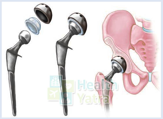 What Should You Know About Hip Replacement Surgery in India?