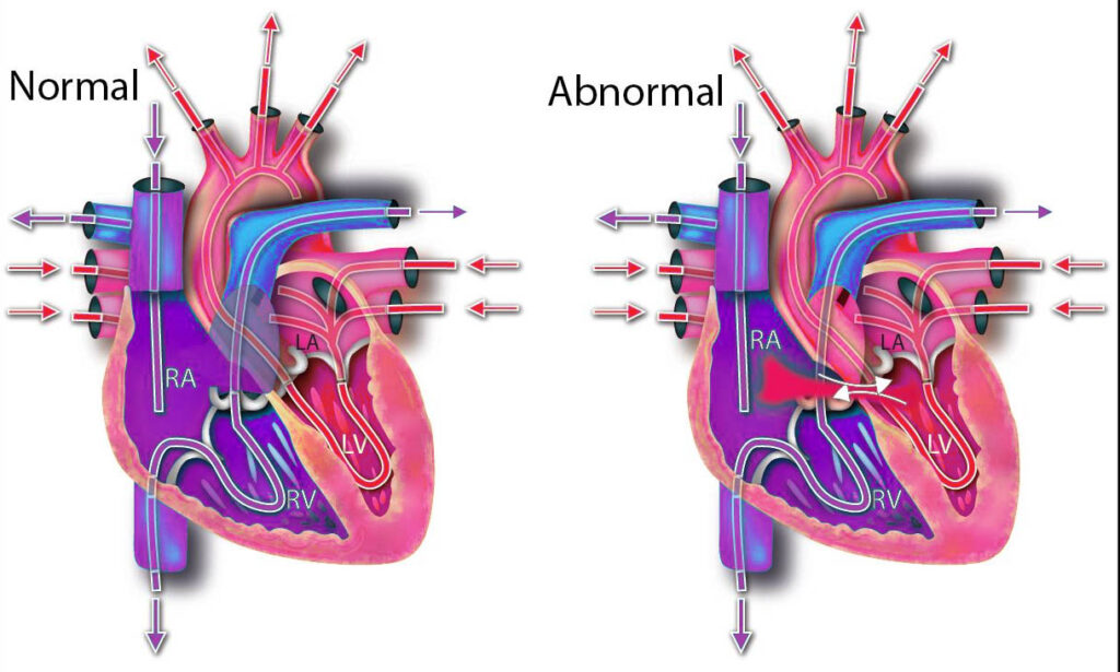 Atrial Septal Defect Surgery in India