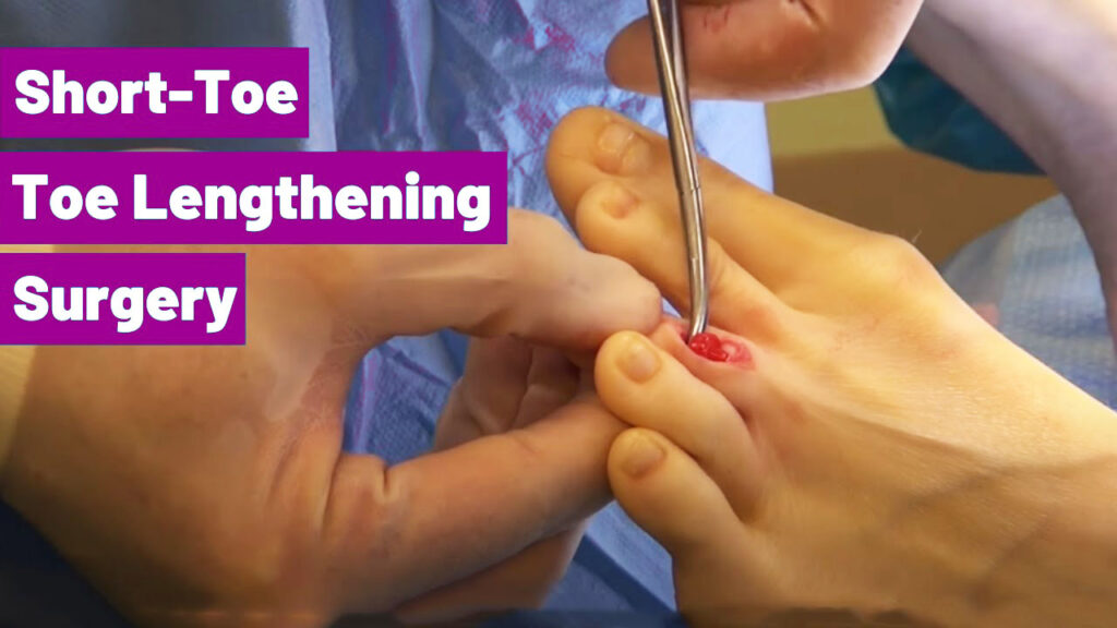 भारत में ब्रैकीमेटाटार्सिया सर्जरी भारत में पैर की उंगलियों को लंबा करने की सर्जरी