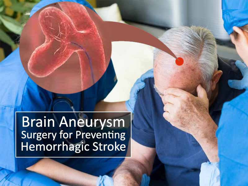 Brain Aneurysm Surgery in India for Preventing Hemorrhagic Stroke