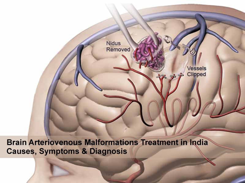 भारत में मस्तिष्क धमनीविस्फार संबंधी विकृतियों का उपचार, कारण लक्षण निदान
