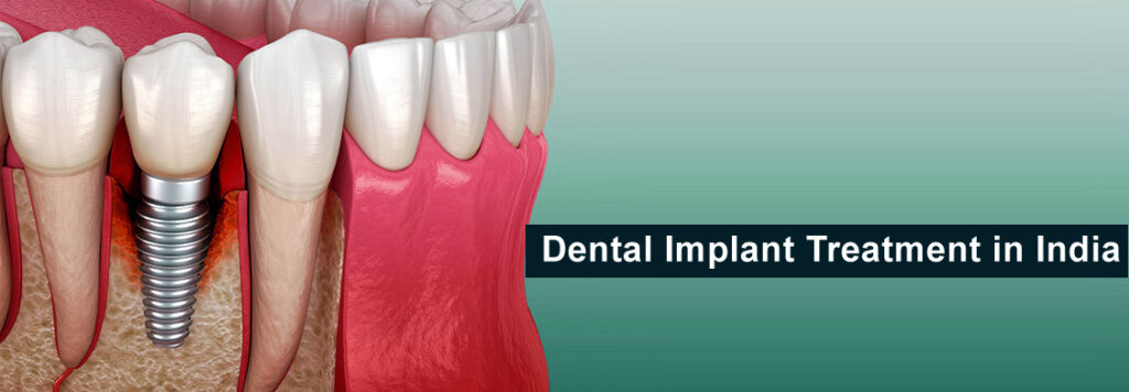 Dental Implant Treatment in India