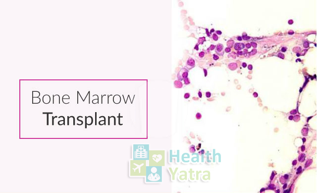 Low Cost bone marrow transplant India