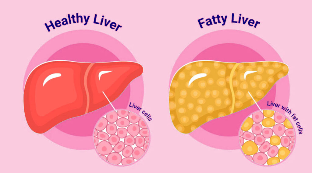 Protect yourself from the effects of a fatty liver.