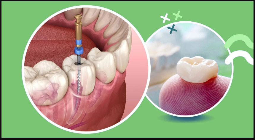 Root Canal Treatment Along With Crowning in India