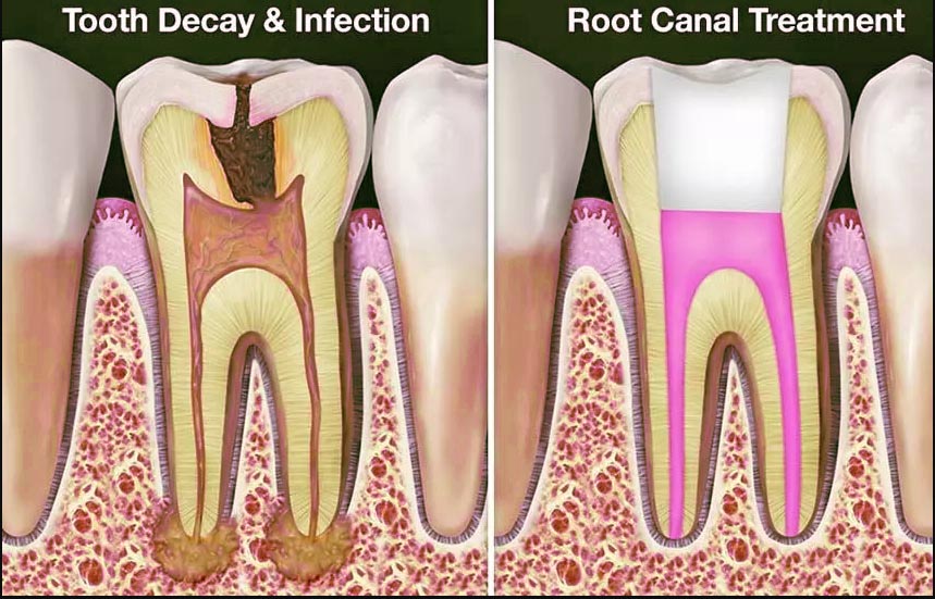 Root Canal Treatment in India