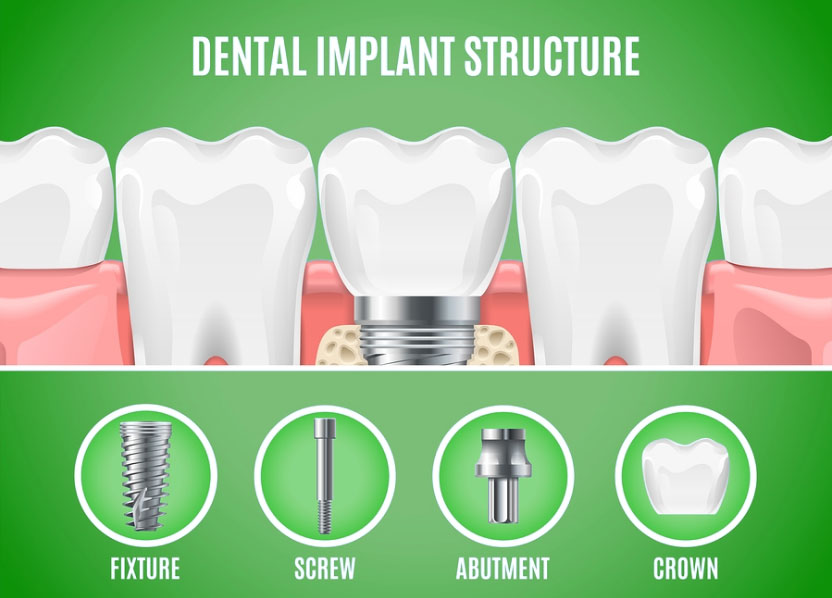 Tooth Implant Crowning Job in India