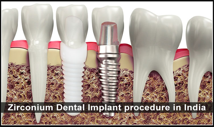 Zirconium Dental Implant procedure in India
