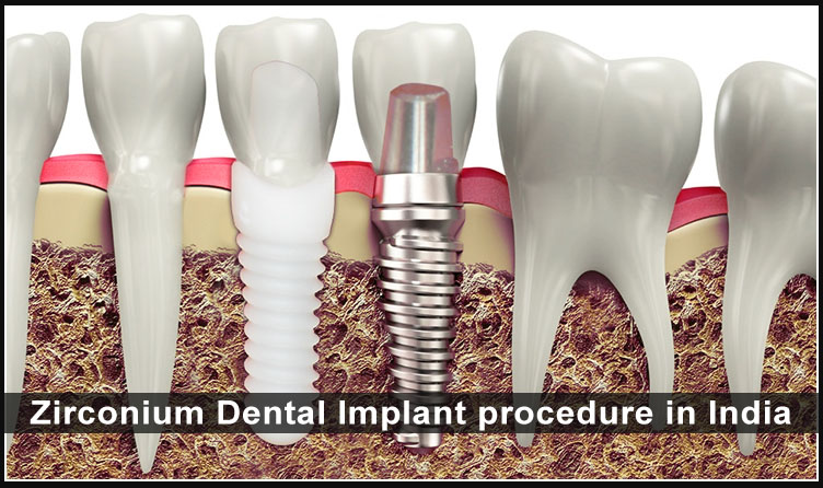भारत में ज़िरकोनियम डेंटल इम्प्लांट प्रक्रिया