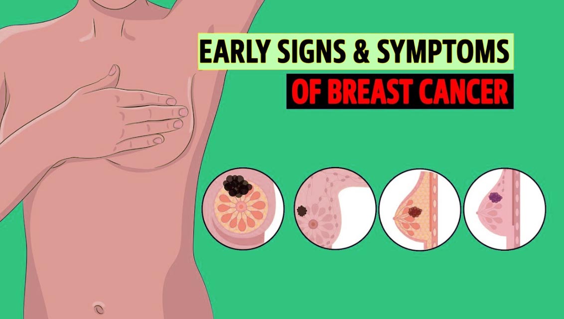 स्तन कैंसर के लक्षण