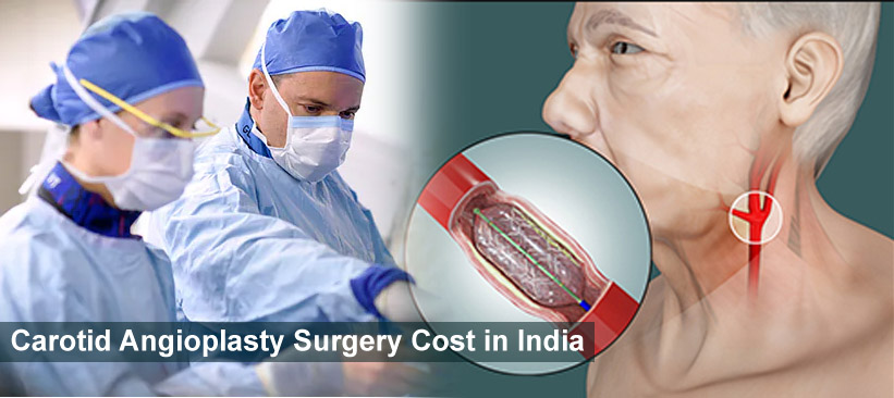 भारत में कैरोटिड एंजियोप्लास्टी सर्जरी की लागत