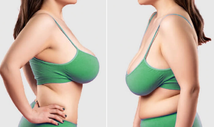 Differences between mammoplasty and mastopexy