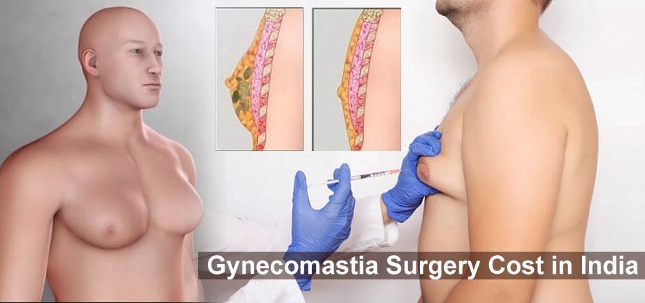 ভারতে Gynecomastia সার্জারির খরচ