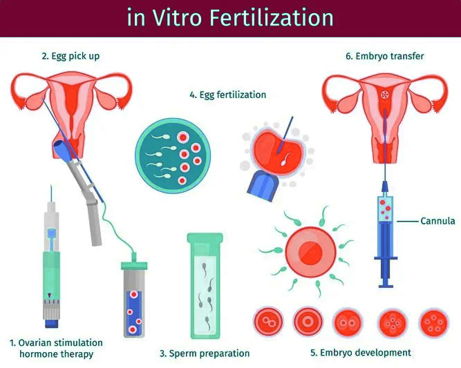 What is involved with in vitro fertilization
