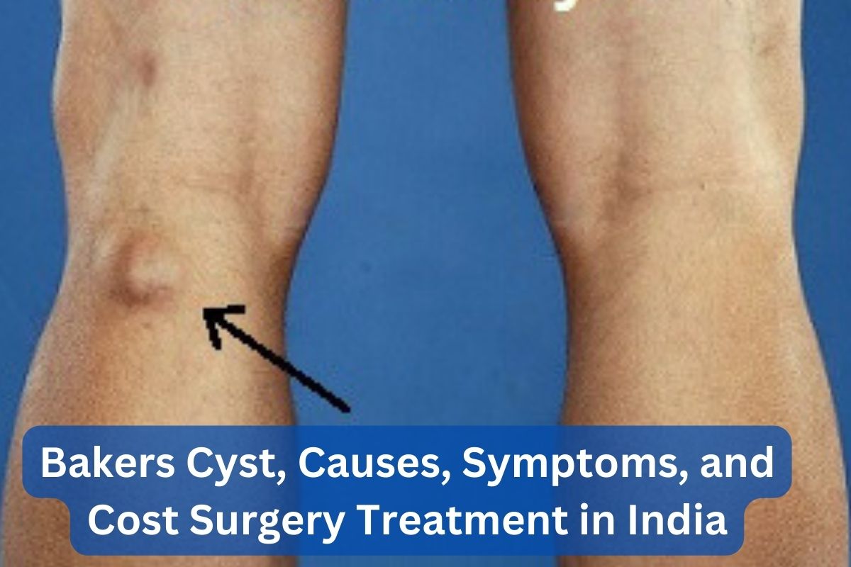 Bakers Cyst Causes Symptoms and Cost Surgery Treatment in India