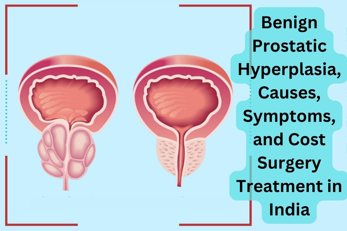 सौम्य प्रोस्टेटिक हाइपरप्लासिया के कारण लक्षण और भारत में सर्जरी की लागत