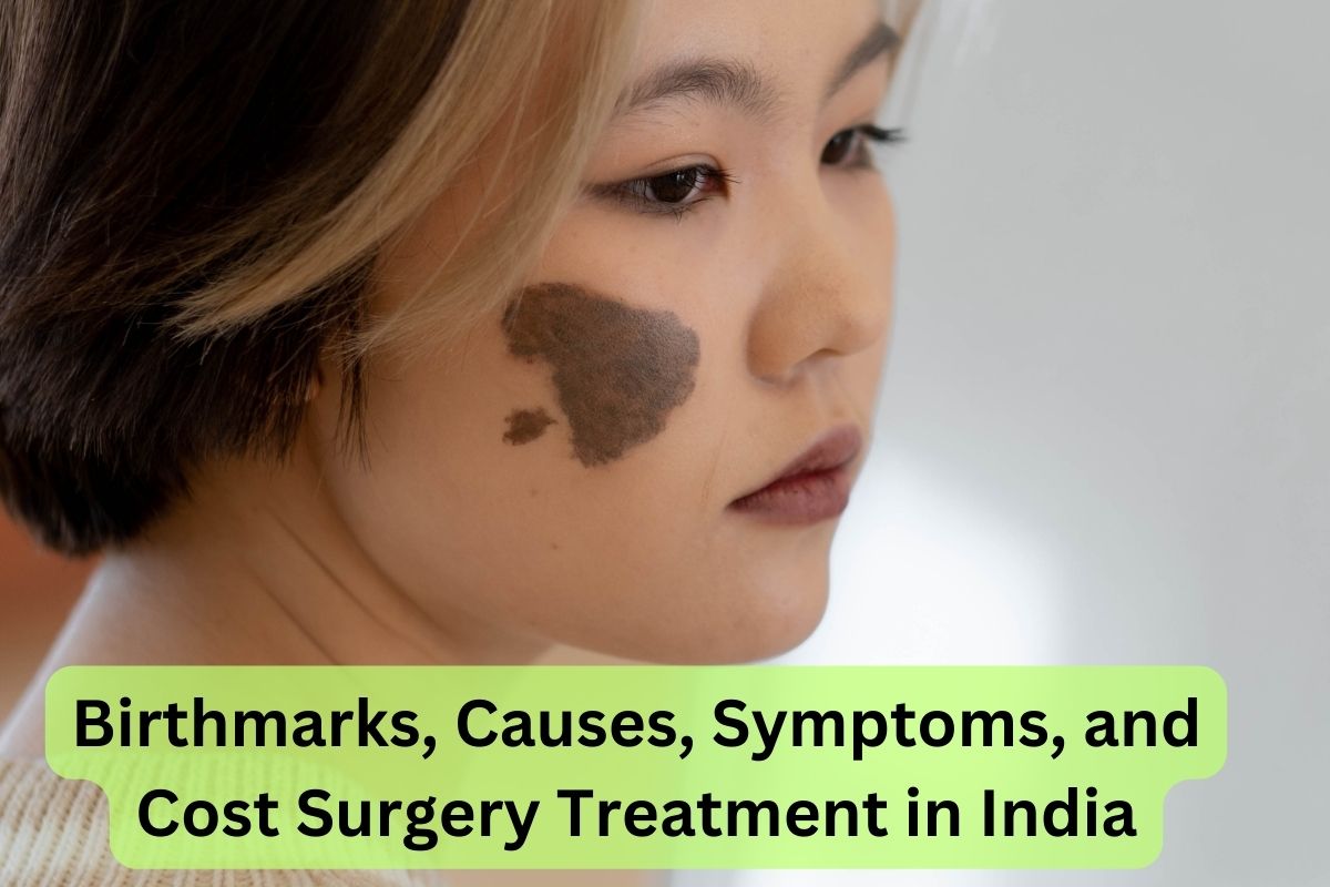 Birthmarks Causes Symptoms and Cost Surgery Treatment in India
