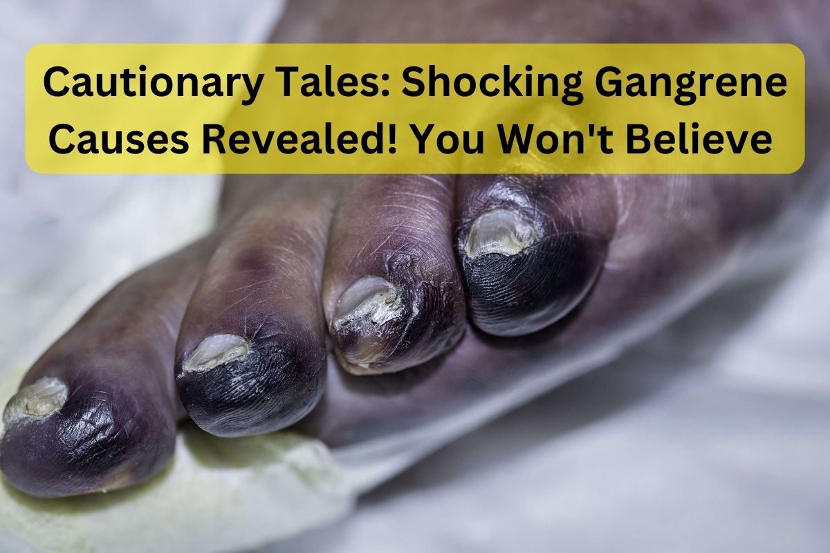 Understanding Gangrene Causes Diagnosis Treatment and Prevention