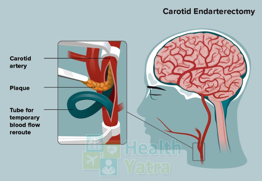 Carotid Endarterectomy Surgery in India