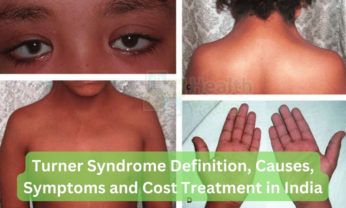 Turner Syndrome Definition Causes Symptoms and Cost Treatment in India