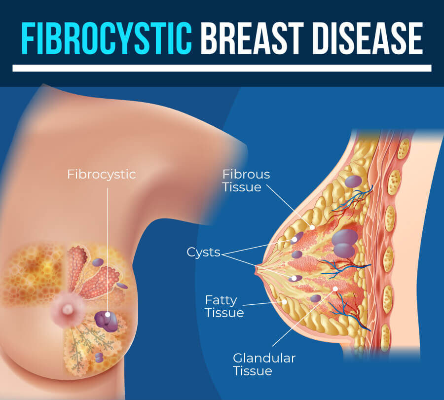 Fibrocystic Disease Treatment in India