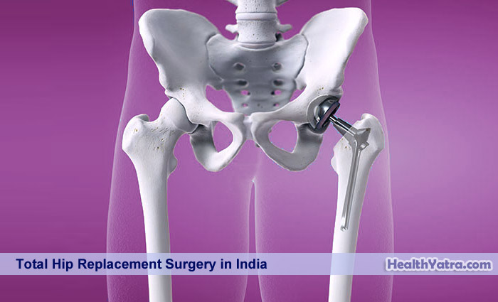 التكلفة الإجمالية لجراحة استبدال الورك في الهند